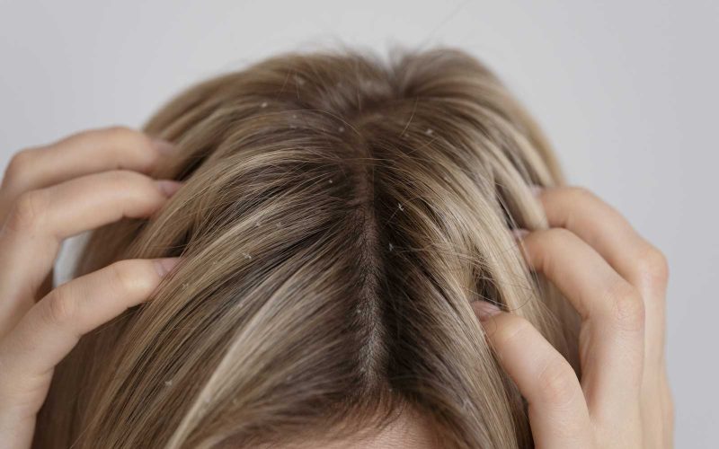 woman-with-dandruff-issues-close-up